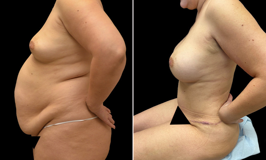 NJ VASER LipoSelection Right Side View Before & After