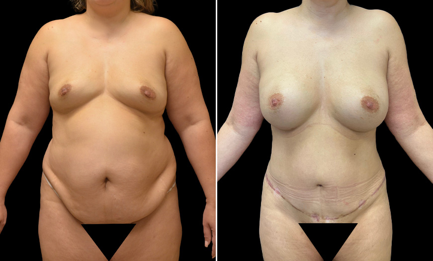 Breast Augmentation, Tummy Tuck, and Lipo Before & After