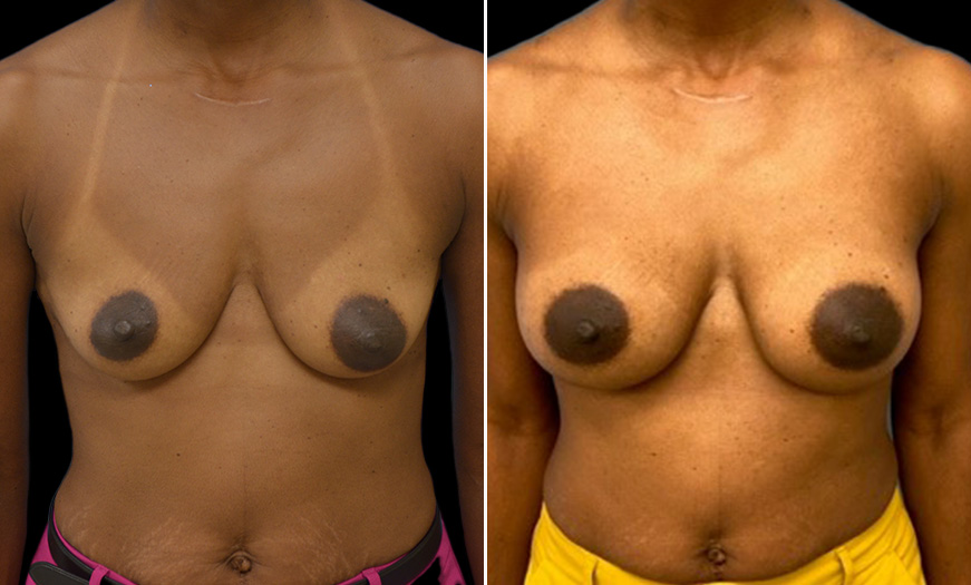 Breast Augmentation Before & After Front View