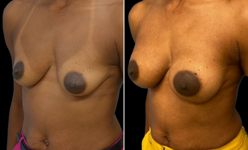 Breast Augmentation Before & After Quarter Left View