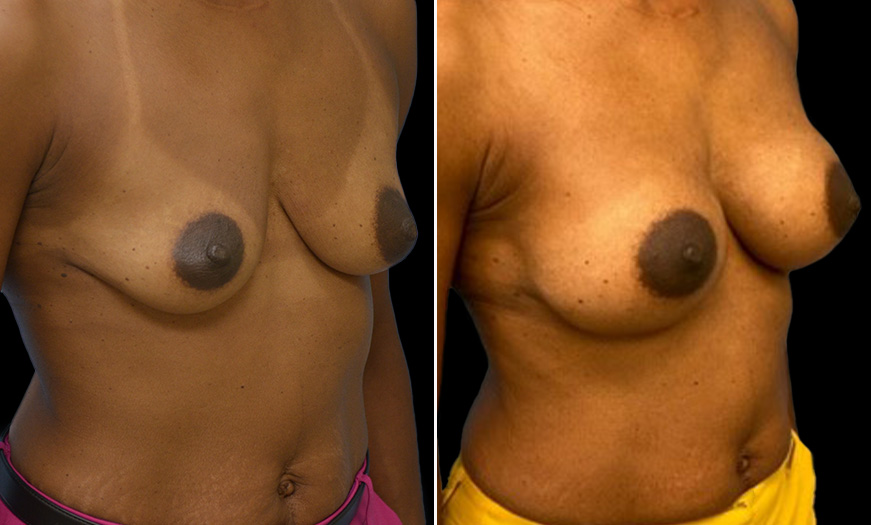 Breast Augmentation Before & After Quarter Right View