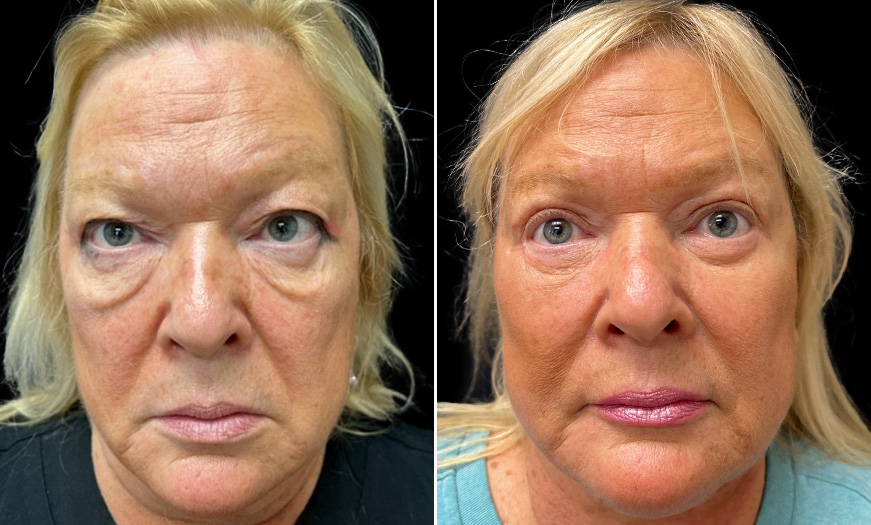 Before & After Bilateral Upper & Lower Blepharoplasty