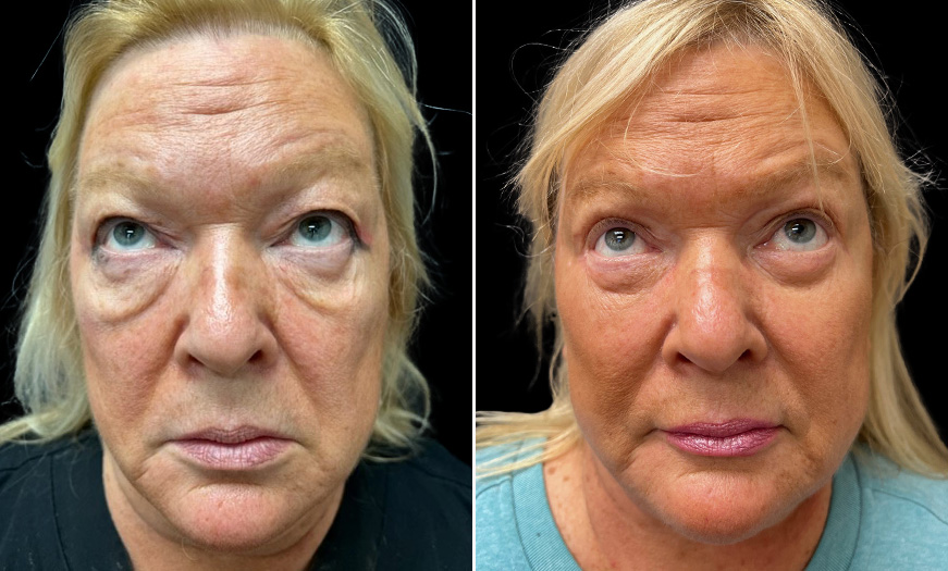 Front View Before & After Bilateral Upper & Lower Blepharoplasty 