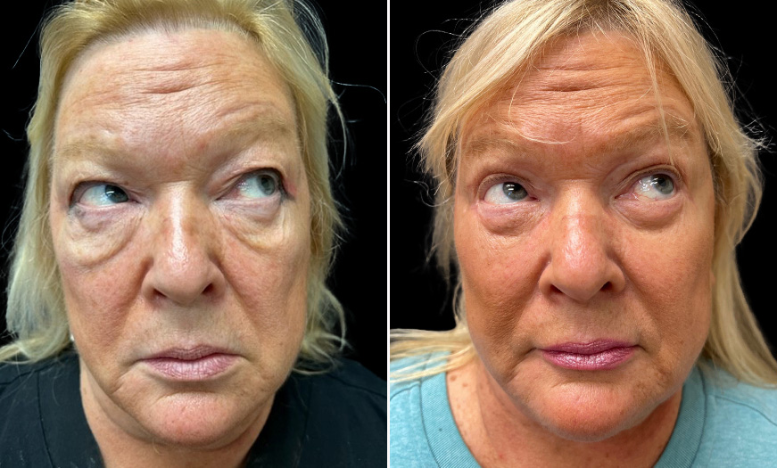 Bilateral Upper & Lower Blepharoplasty Before & After Front View