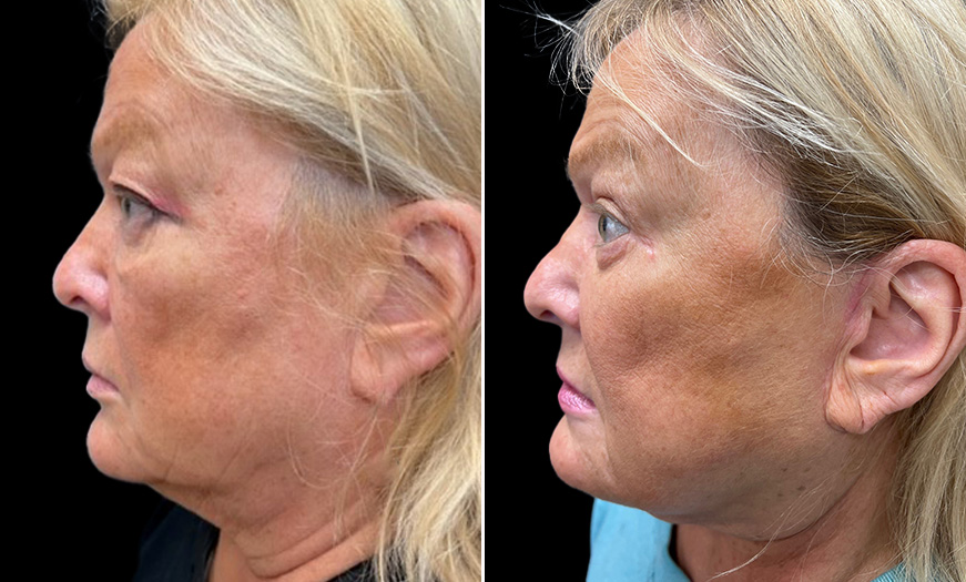 Bilateral Upper & Lower Blepharoplasty Before & After