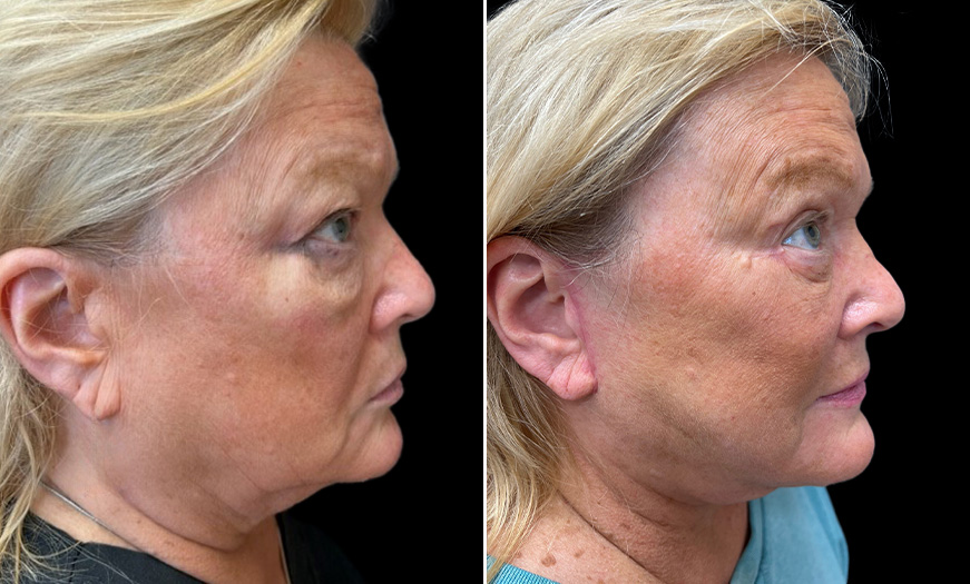 Before & After Bilateral Upper & Lower Blepharoplasty Side View