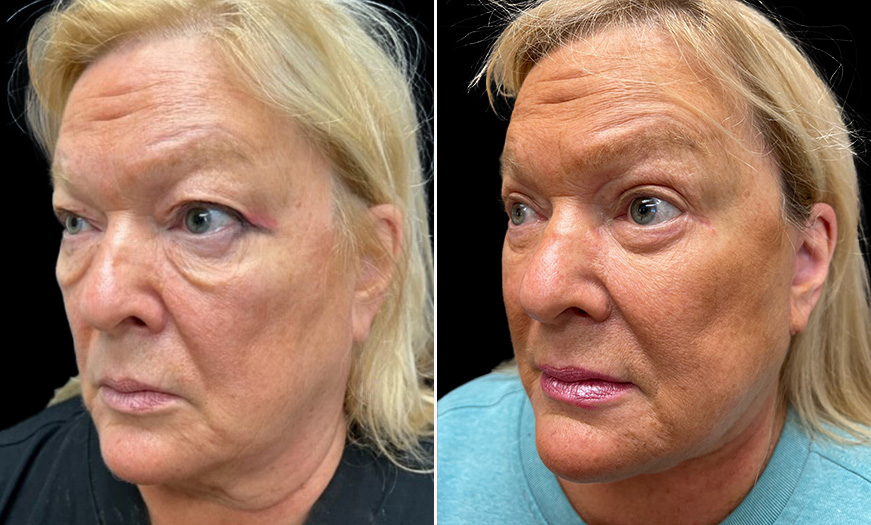 Face & Neck Lift Before and After Quarter Left View