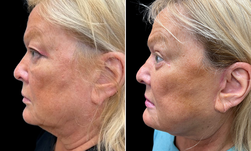 Face & Neck Lift Before and After Side Left View 