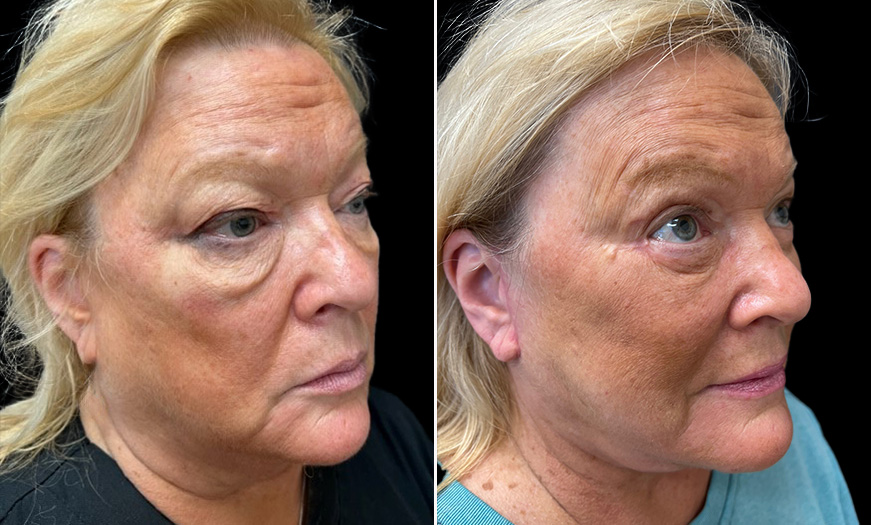 Face & Neck Lift Before and After Quarter Right View