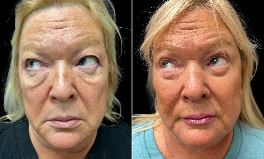 Front View Festoon Correction, Blepharoplasty, Facelift, & Neck Lift