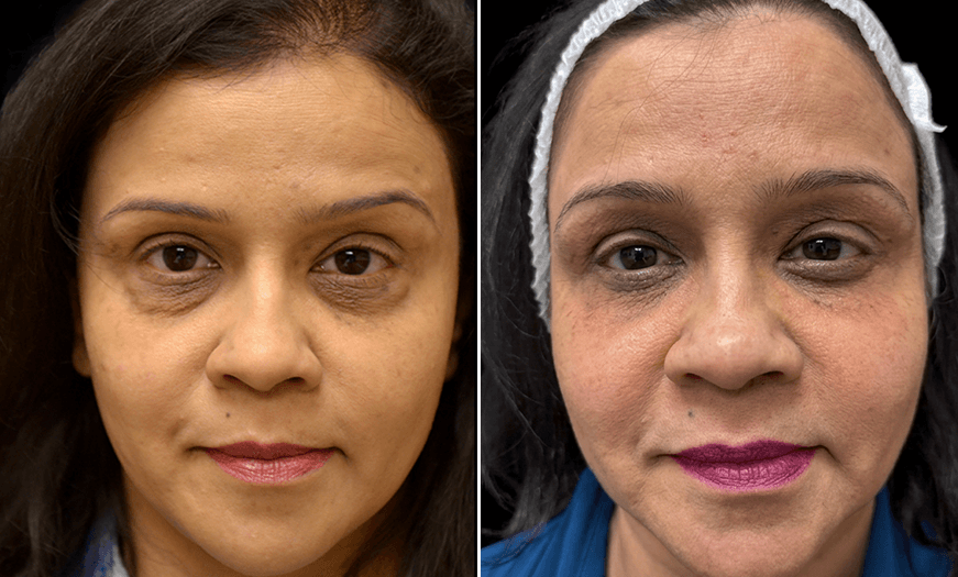 Results Of Lower Eyelid Surgery