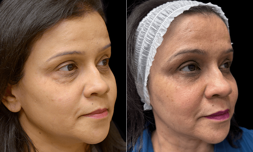 Results Of Lower Eyelid Surgery 3/4 Right View