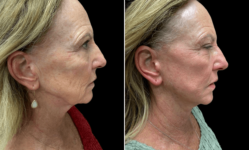 Before & After Face Lift/Neck Lift Right View