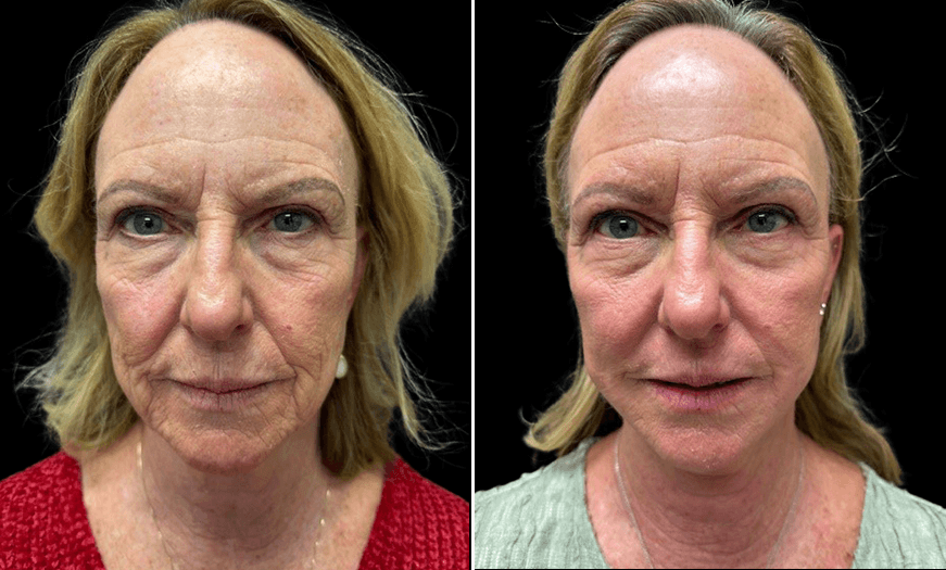 Lower Bleph Before & After