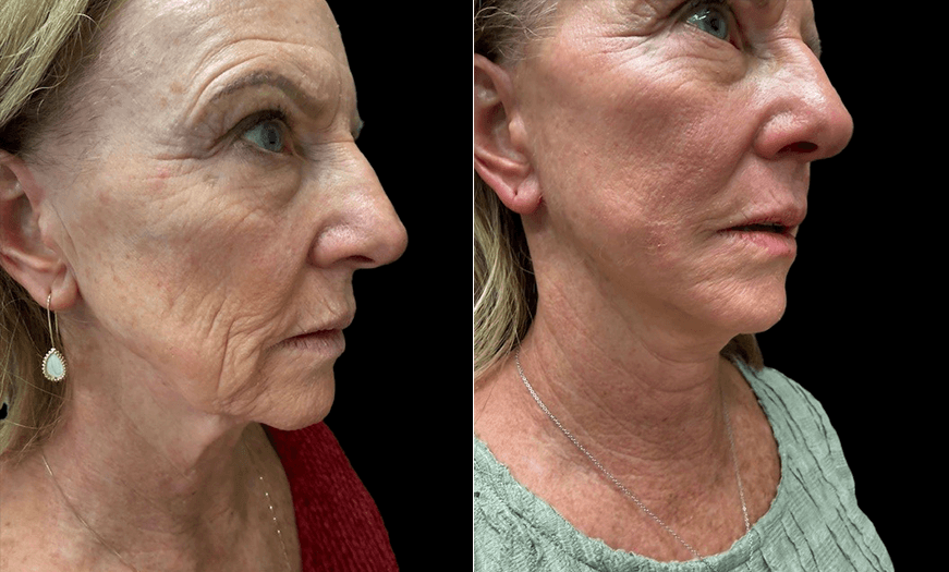 Lower Bleph Before & After Lower View
