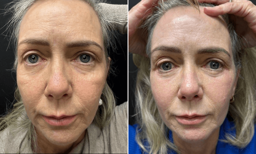 Festoon Surgery Before And After