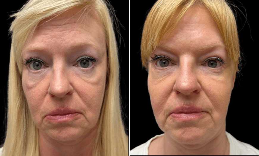 Before And After Festoon Surgery