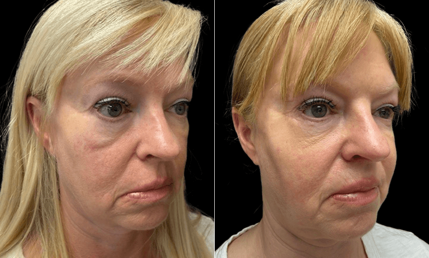 Results Of Festoon Surgery 3/4 Right View