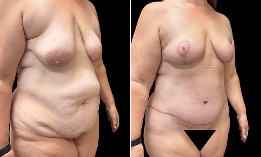Results Of Breast Lift Surgery 3/4 Right View
