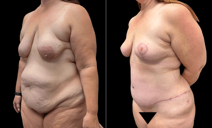 Results Of Breast Lift Surgery 3/4 Left View