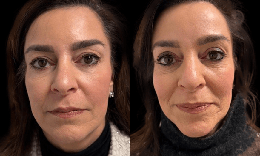Upper Eyelid Surgery Results