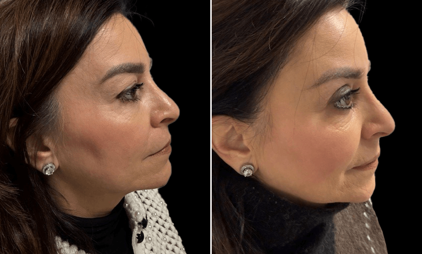 Upper Eyelid Surgery Results Right View