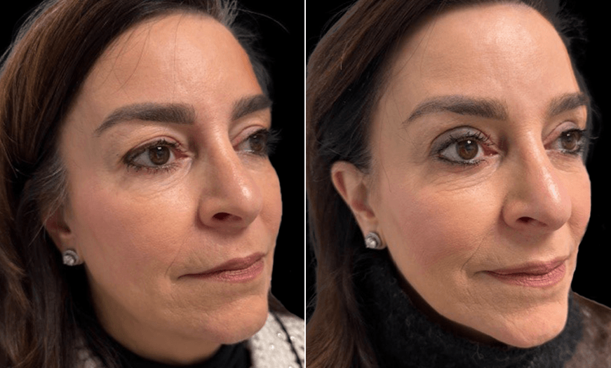 Upper Eyelid Surgery Results 3/4 Right View
