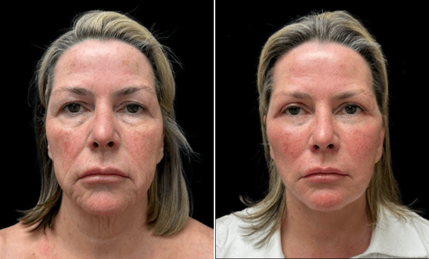 Facelift/Neck Lift Results