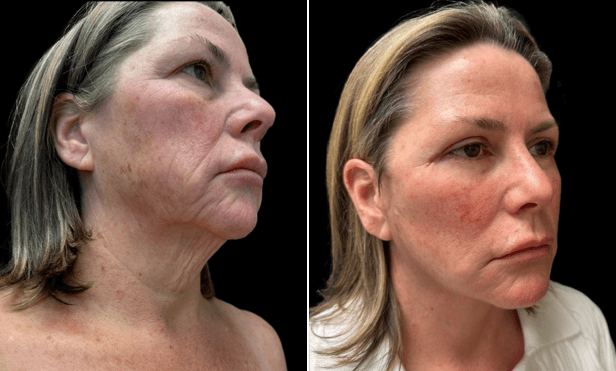 Facelift/Neck Lift Results 3/4 Right View