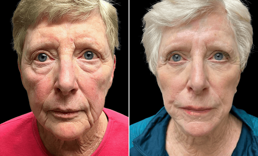 Results Of Foreheadplasty