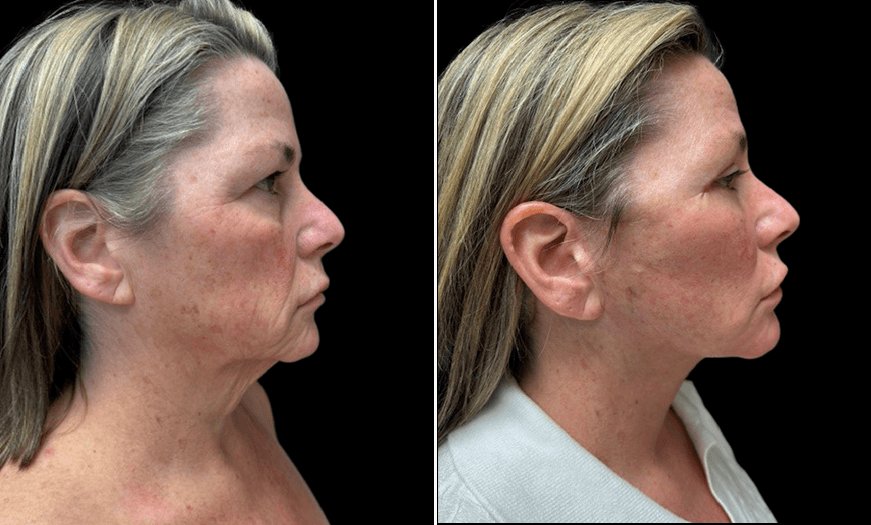 Results Of Facial Fat Grafting Right View