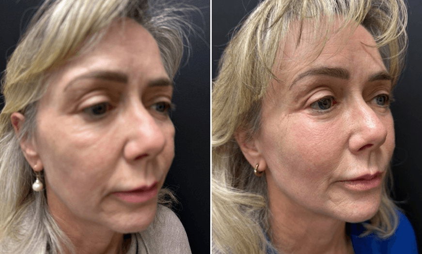 Foreheadplasty 3/4 Right View