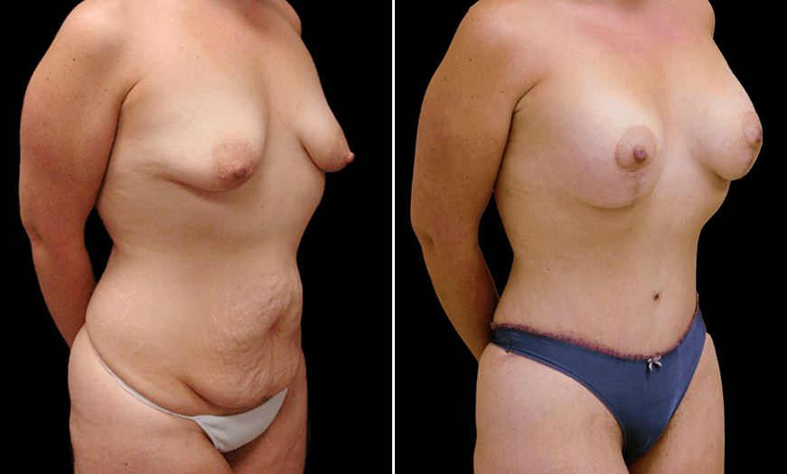 Results Of Tummy Tuck Surgery 3/4 Right View