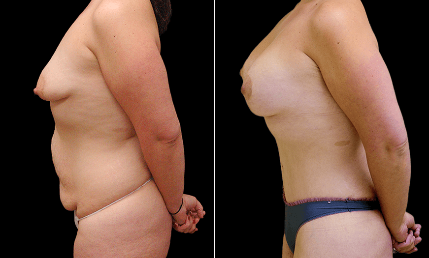 Results Of Tummy Tuck Surgery Left View