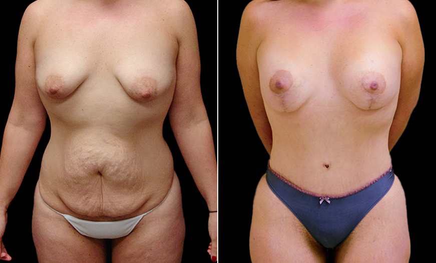 Before & After VASER LipoSelection Front View