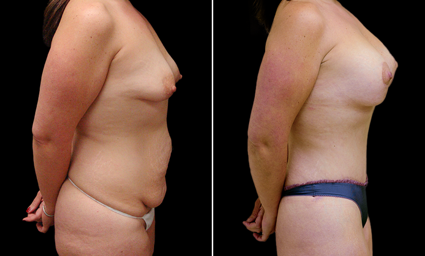 Before & After VASER LipoSelection Side Right View