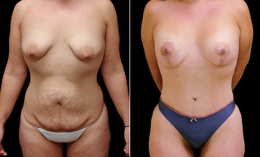 Before & After Core Abdominoplasty Front View