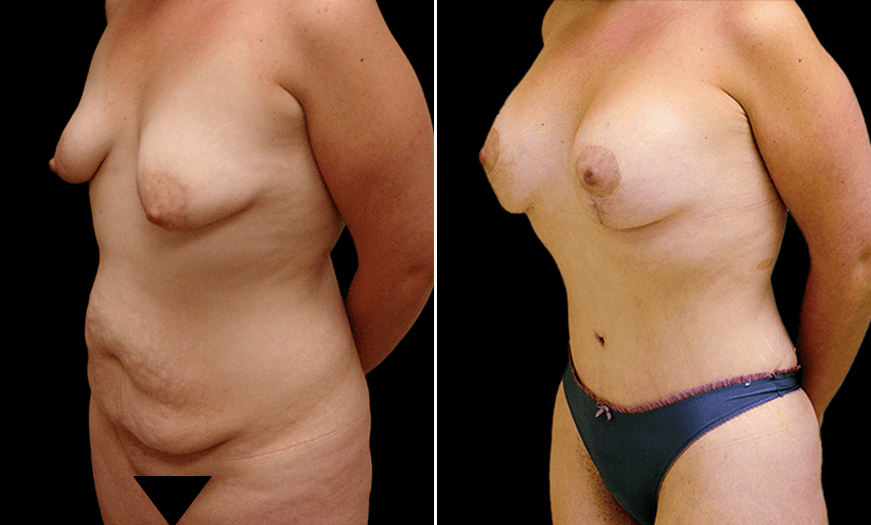 Before & After Core Abdominoplasty Quarter Left View