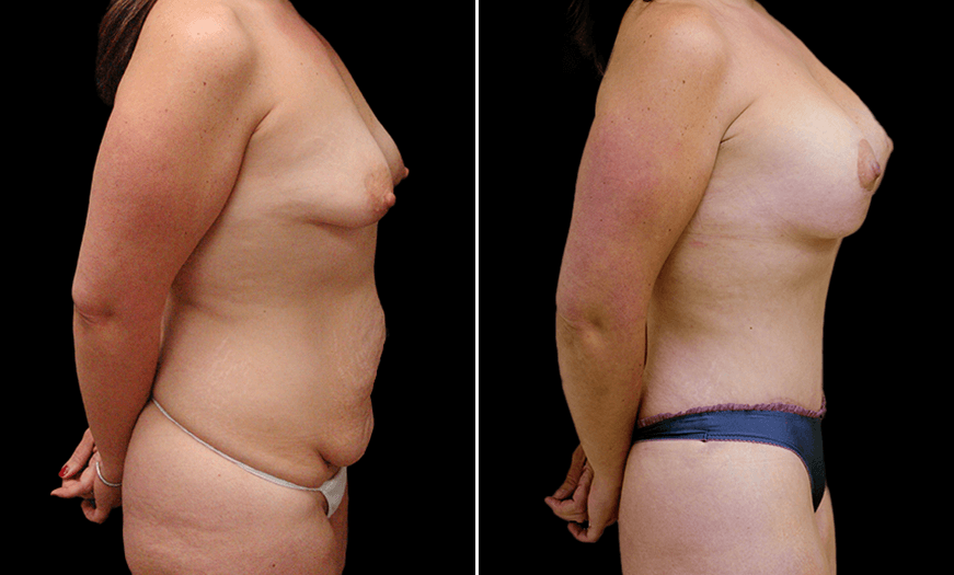Before & After Breast Augmentation Side Right View