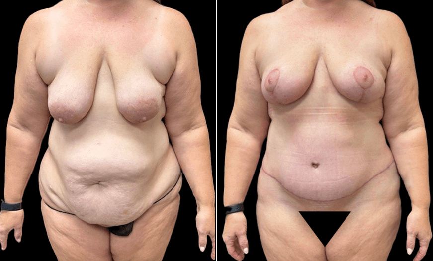 Results Of Panniculectomy & Breast Lift