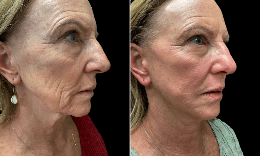 Before & After Facial Plastic Surgery 3/4 Right View