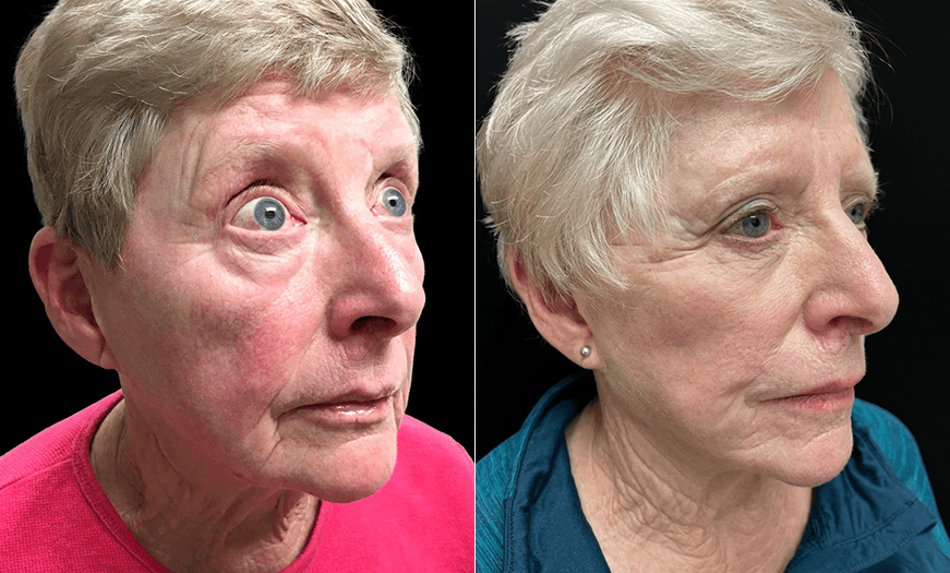 Before And After Facial Plastic Surgery 3/4 Right View