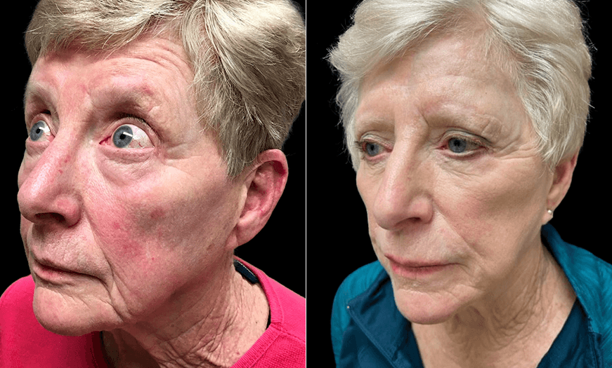 Before And After Facial Plastic Surgery 3/4 Left View