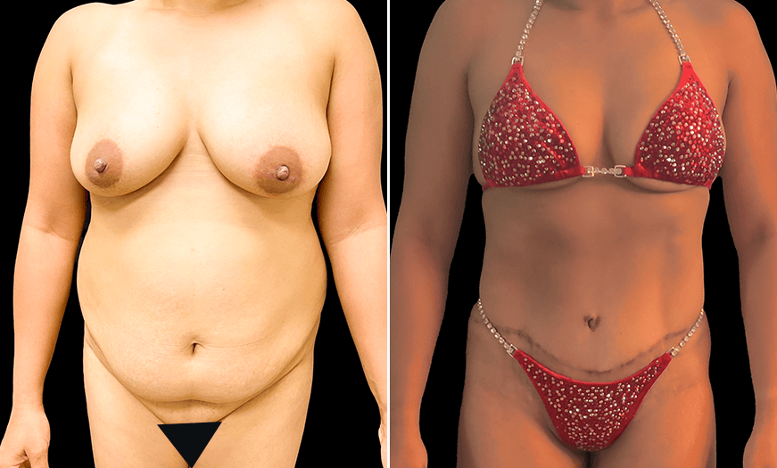 Body Plastic Surgery Before & After