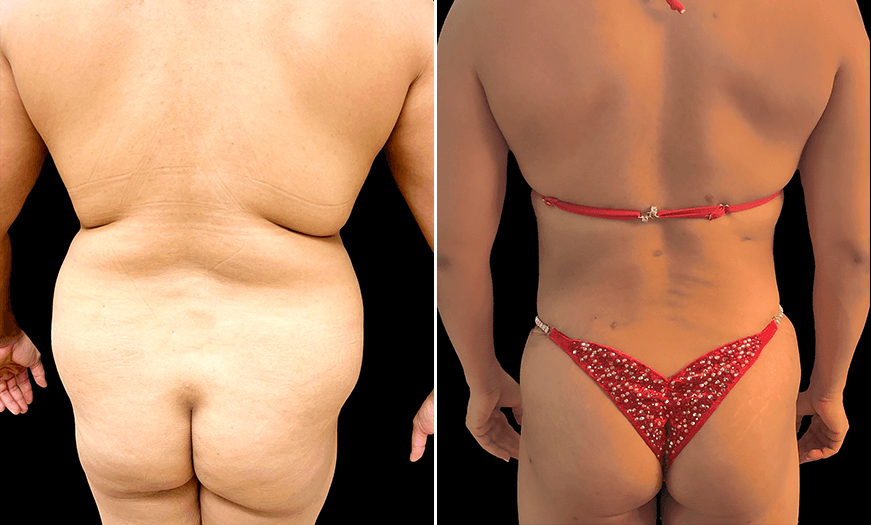 Tummy Tuck Surgery Before And After Back View