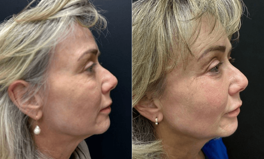 Facial Plastic Surgery Before & After Right View
