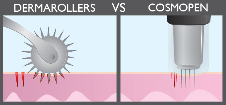 Dermarollers Vs CosmoPen