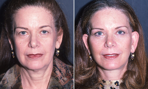 Facelift Before And After