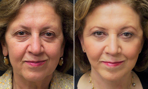 Before And After Facelift Surgery