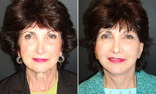 Facelift Results